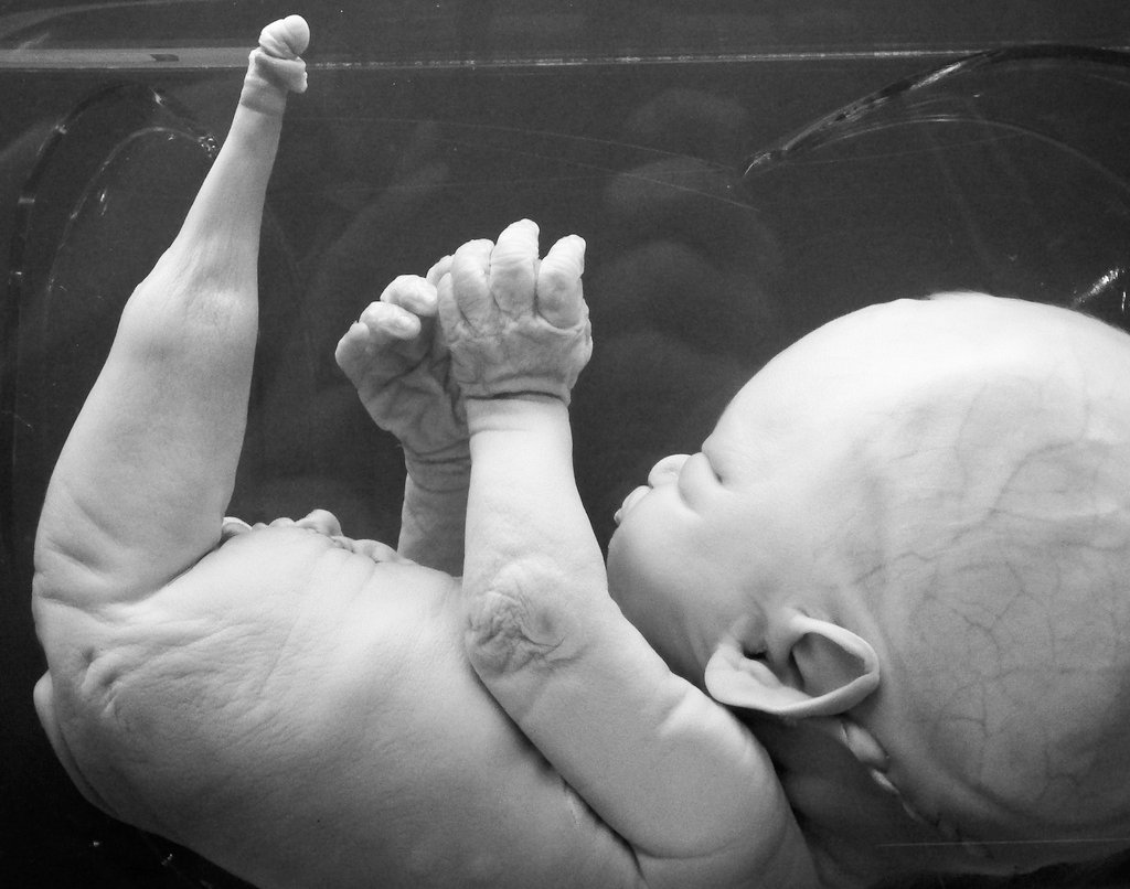 Denizkızı hastalığı