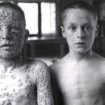 Türklerde çiçek aşısı